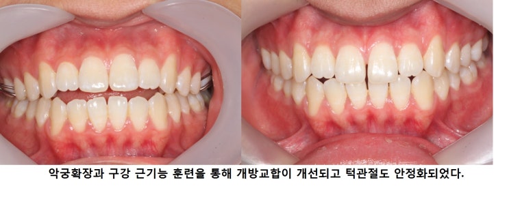  조기접촉에 의한 개방교합