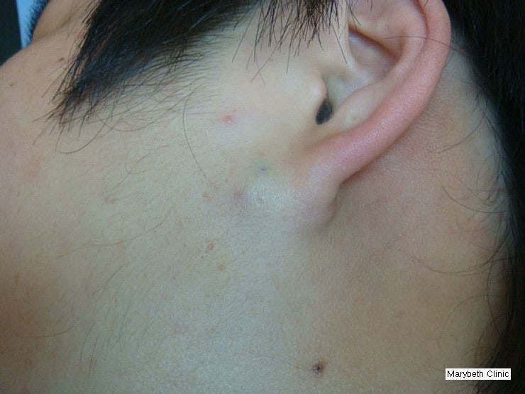 1. 표피낭종(表皮囊腫, Epidermal cyst) [요약][진단][치료] - 제30장. 피부 및 피하조직의 모낭낭 - 한국에 ...