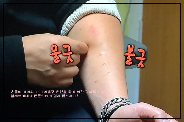 몸 가려움증 온몸이 간지러워요 손 발 4