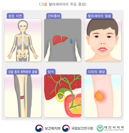 지중해성 빈혈, 겸자적혈구빈혈, Sicklecelltrait, anemia and Thalassemia