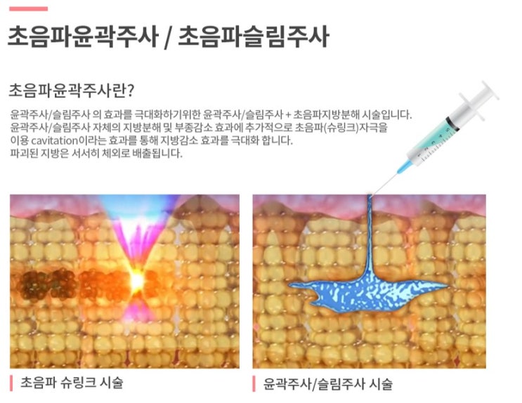  [삼성역, 봉은사역피부과] 실리프팅 + 윤곽주사 - 삼성중앙역ST성모피부과