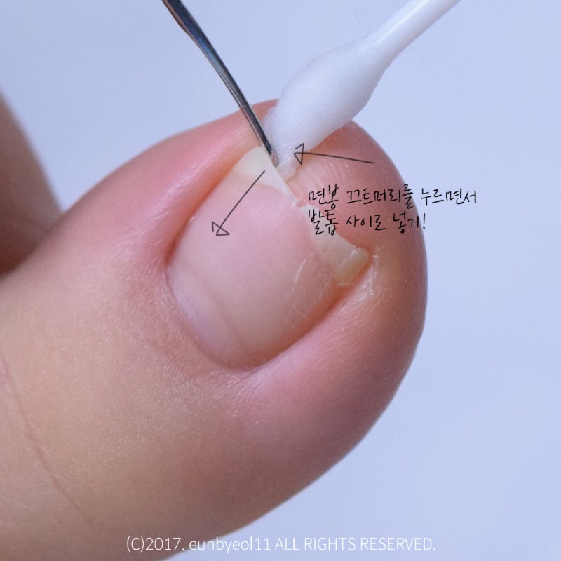 내성발톱 끝장낸 후기 (부제 : 이 쥬길놈의 파고드는 발톱) : 네이버 블로그
