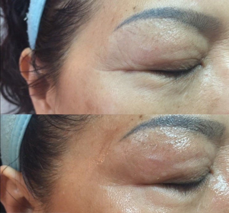  눈가잔주름 안티에이징관리 확실한제품 (마포,여의도더샵21)