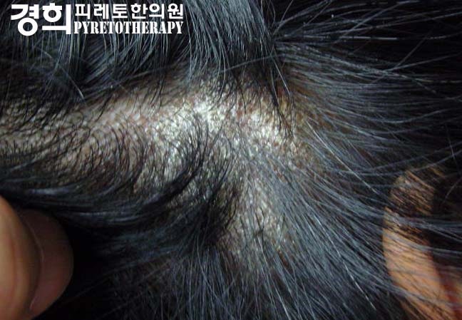 두부백선, 두피백선 - 근본적인 치료법은? : 네이버 블로그