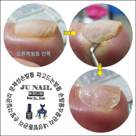 지긋지긋한내성발톱/분당용인수원수지보정동백죽전동/주네일/파고드는발톱 지긋지긋한내성발톱/분당용인수원수지보정동백죽전동/주네일/파고드는발톱