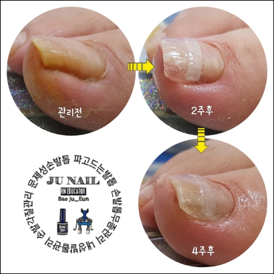 내성발톱/분당용인수원수지보정동백죽전동/주네일/파고드는발톱 