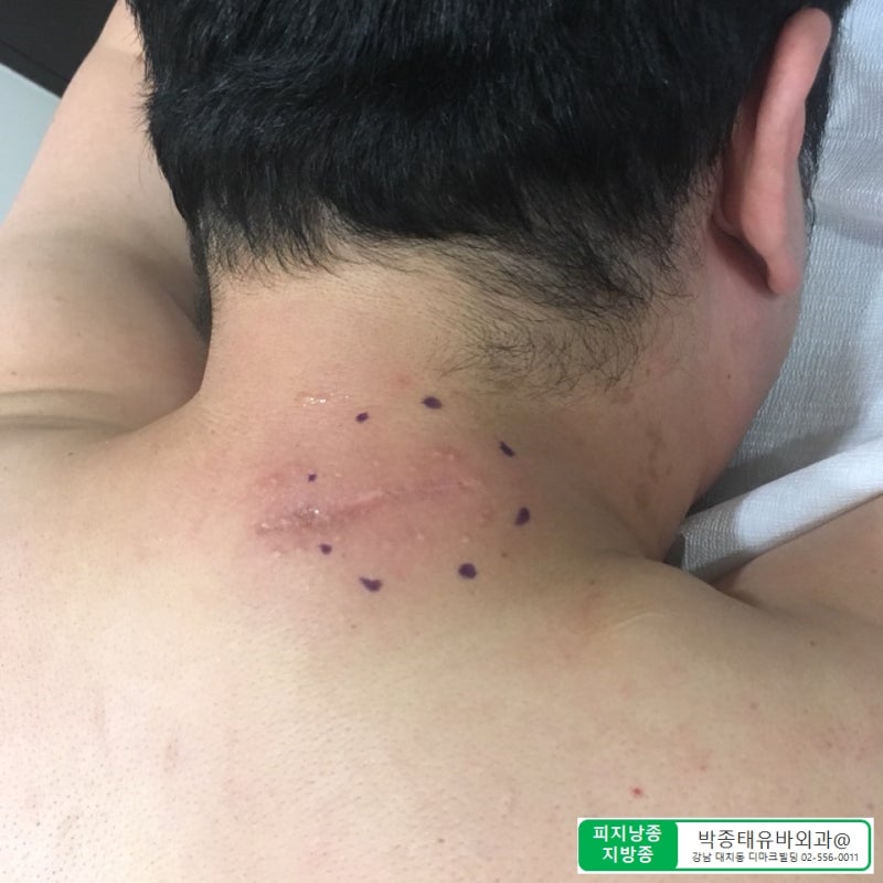 [Dr.ParK] 등 깊숙한 곳에서 혹이 만져집니다. 근막에 둘러싸인 지방종 제거 수술 9
