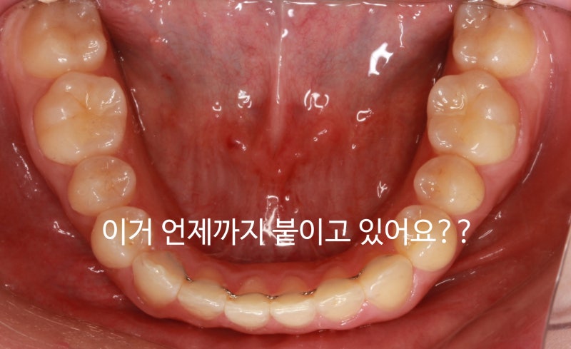 교정 유지장치 제거시기 ; 교정과 의사가 알려드리는 교정유지기간? : 네이버 블로그 교정 유지장치 제거시기 ; 교정과 의사가 알려드리는 교정유지기간? : 네이버 블로그
