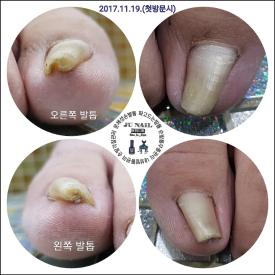 고난이도! 아주심한내향성발톱 용인 주네일에서 관리 받았어요./분당용인수원수지보정동백죽전동/주네일/파고드는발톱 