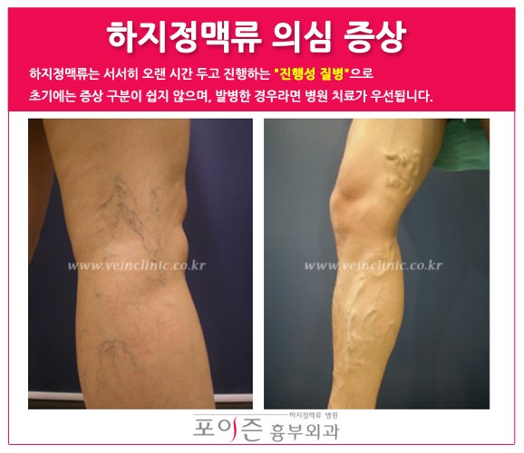 부평 하지정맥류 망설이지말고