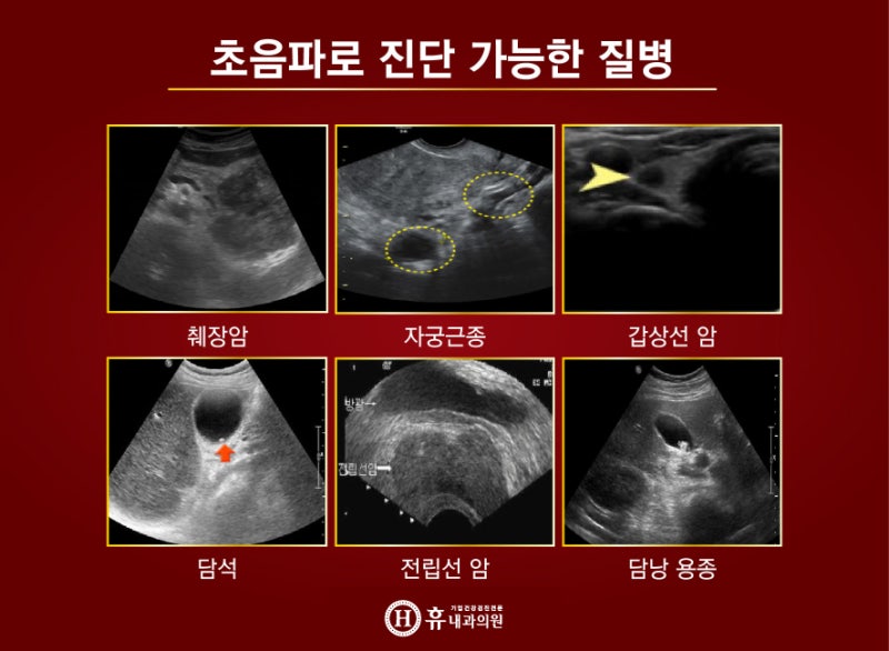 담낭염과 담석증 원인증상 치료방법까지!
