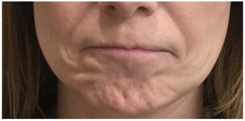 강남구청역 울쎄라행사팔자주름,턱밑살,이중턱리프팅