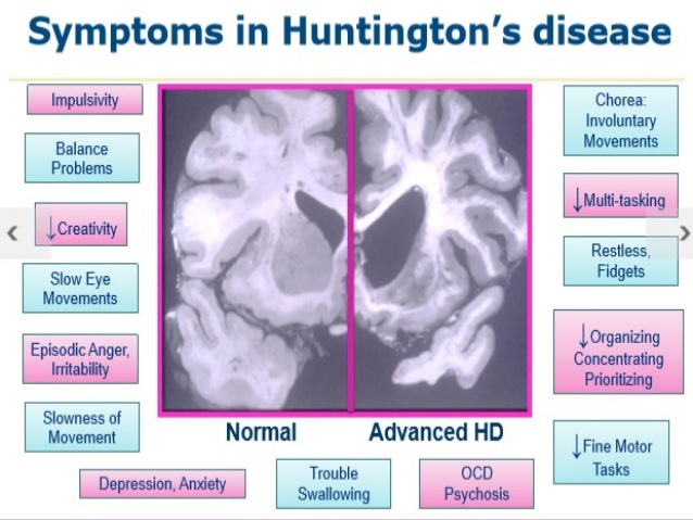 헌팅턴병 연구 Study: Cannabinoid Therapy Improves Dystonia In HD Patients