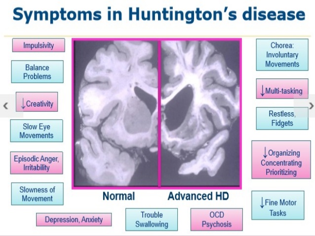 헌팅턴병 연구 Study: Cannabinoid Therapy Improves Dystonia In HD Patients