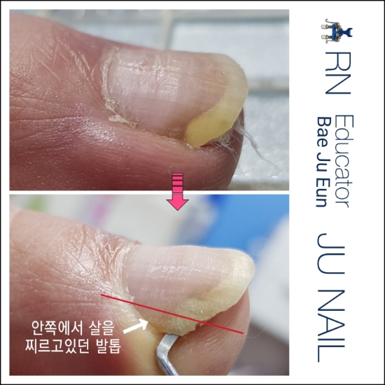 무서운조갑감입증/분당용인수원수지보정동백죽전동/주네일/파고드는발톱 무서운조갑감입증/분당용인수원수지보정동백죽전동/주네일/파고드는발톱