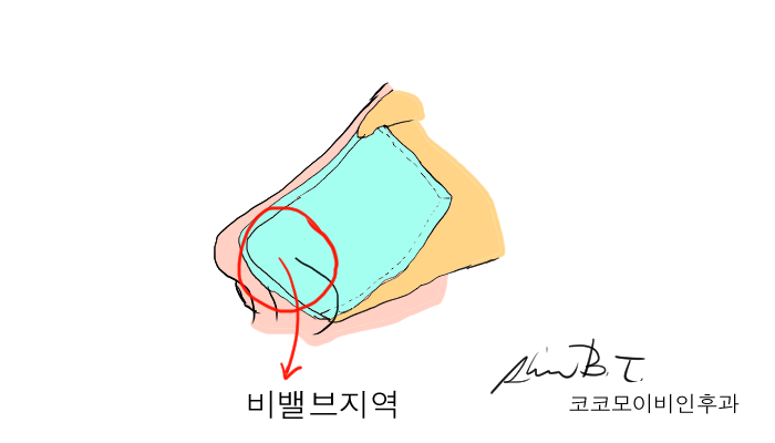  비중격만곡증수술 잘하는 곳, 바로 여기 코코모이비인후과
