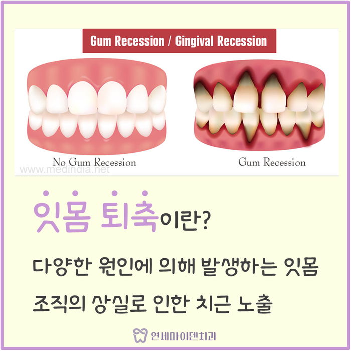 잇몸 내려앉음 잇몸 퇴축 현상이 나타나는 원인과 치료법은? : 네이버 블로그