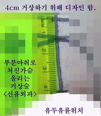가슴보형물제거하며 처진가슴올리는 거상술, 맘모톰수술까지 동시에