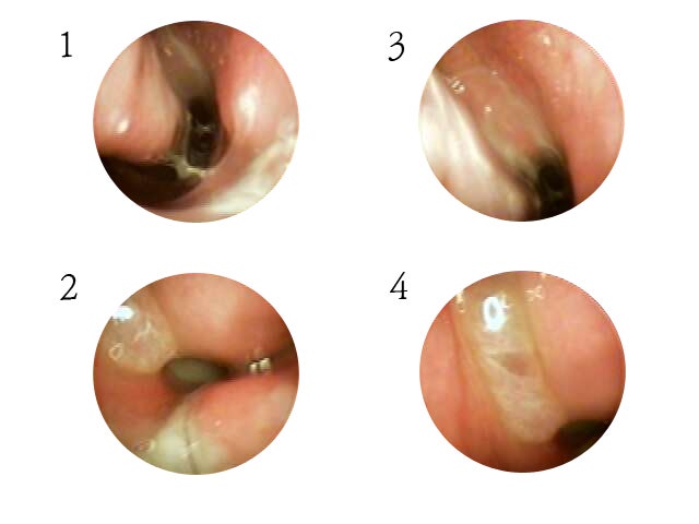 Causes of Yongsan Nasolacrimal Acupuncture