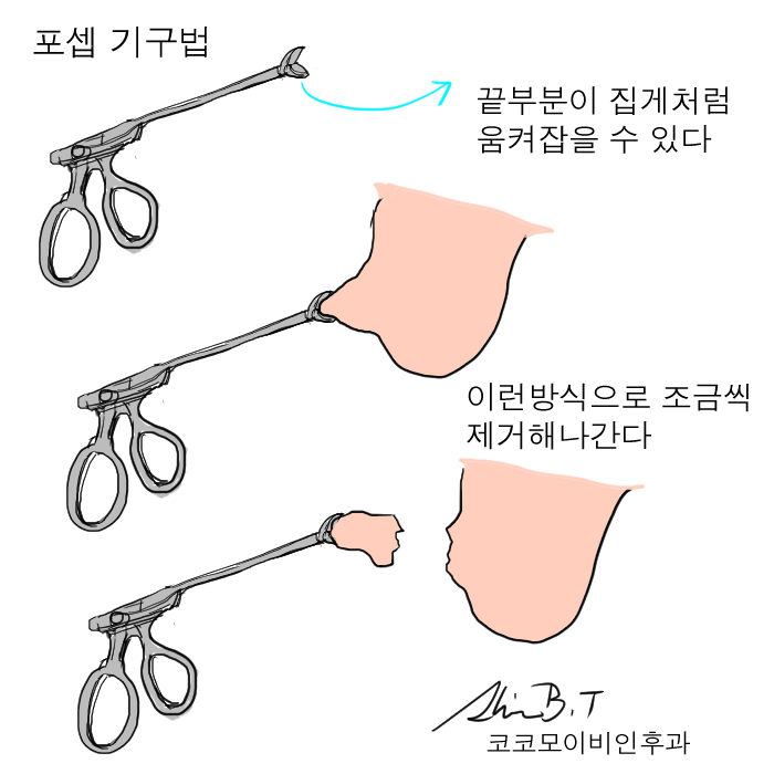  코물혹수술 하면 코코모 이비인후과, 비용종 수술기구의 비교