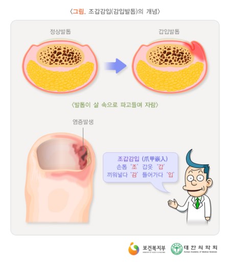 조갑감입/분당용인수원수지보정동백죽전동/주네일/파고드는발톱 조갑감입/분당용인수원수지보정동백죽전동/주네일/파고드는발톱
