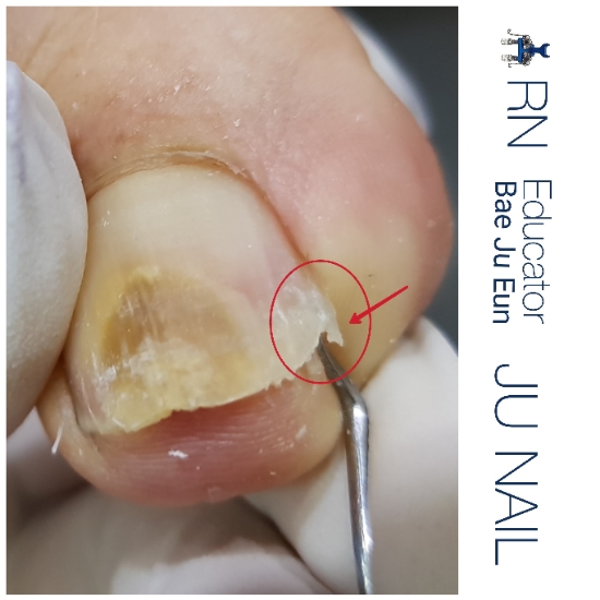 원인은 잘못깍은발톱과무좀/분당용인수원수지보정동백죽전동/주네일/파고드는발톱 