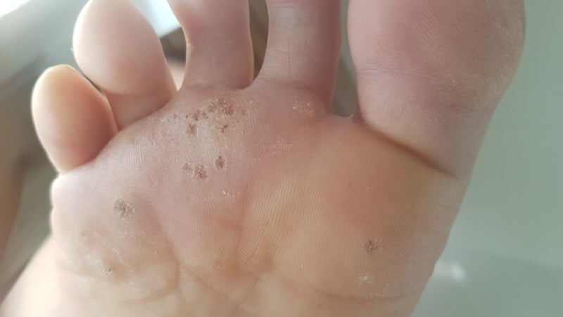 족저사마귀 율무 사용 중간경과 솔직후기