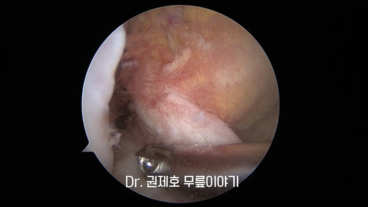  무릎전방십자인대파열 관절이 불안하다면