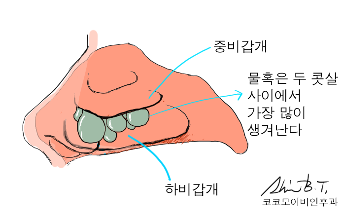  코물혹 수술에서 사용되는 코코모 이비인후과의 통증없는 녹는솜