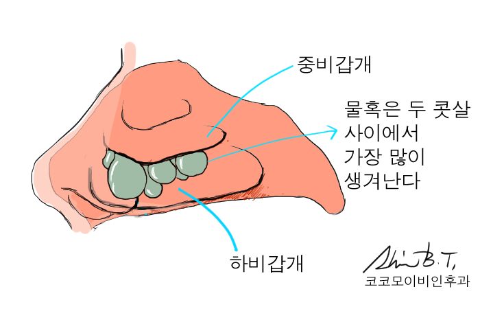 코물혹 수술에서 사용되는 코코모 이비인후과의 통증없는 녹는솜