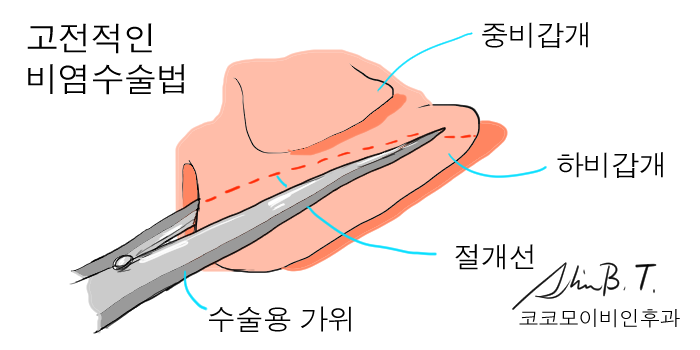  비후성비염수술을 위한 안전하고 간편한 고주파 장비