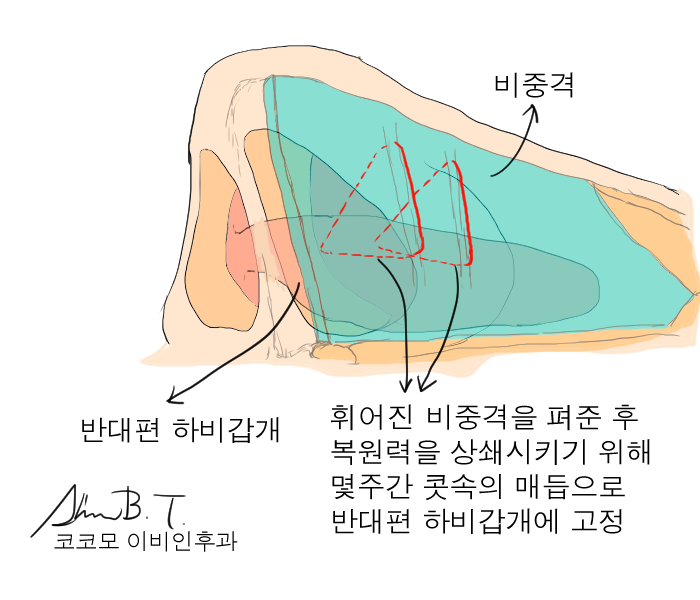  비중격만곡증 수술후 지혈솜과 그 제거시 통증이 걱정되시나요?