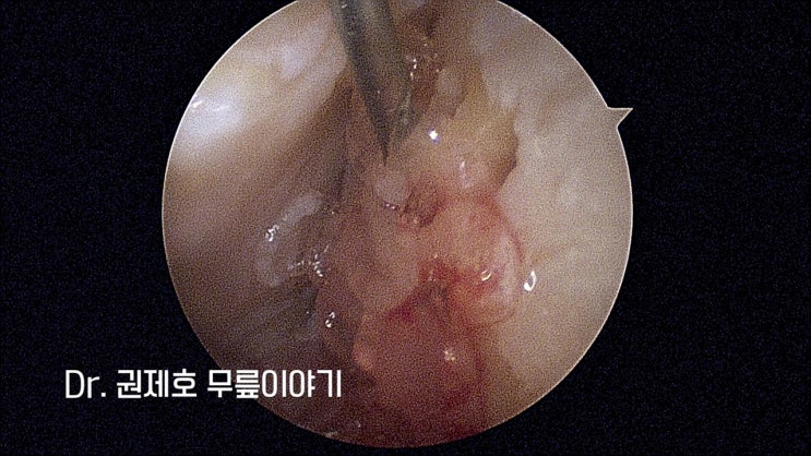  무릎연골재생수술 다시 젊어지는 관절