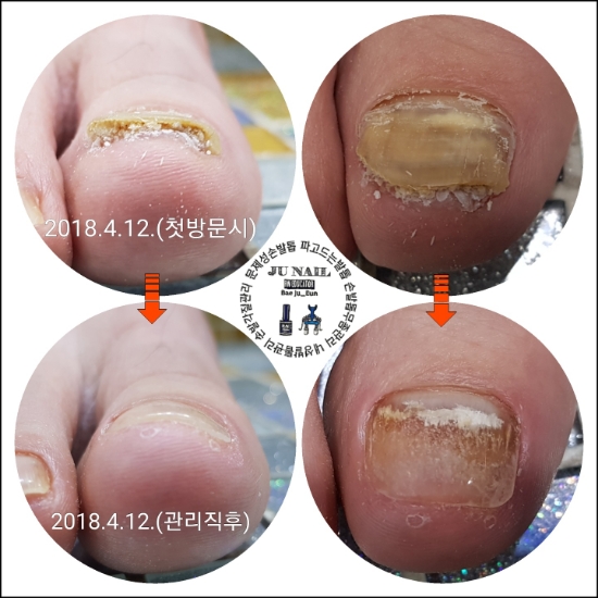 심한무좀발톱/분당용인수원수지보정동백죽전동/주네일/파고드는발톱 심한무좀발톱/분당용인수원수지보정동백죽전동/주네일/파고드는발톱