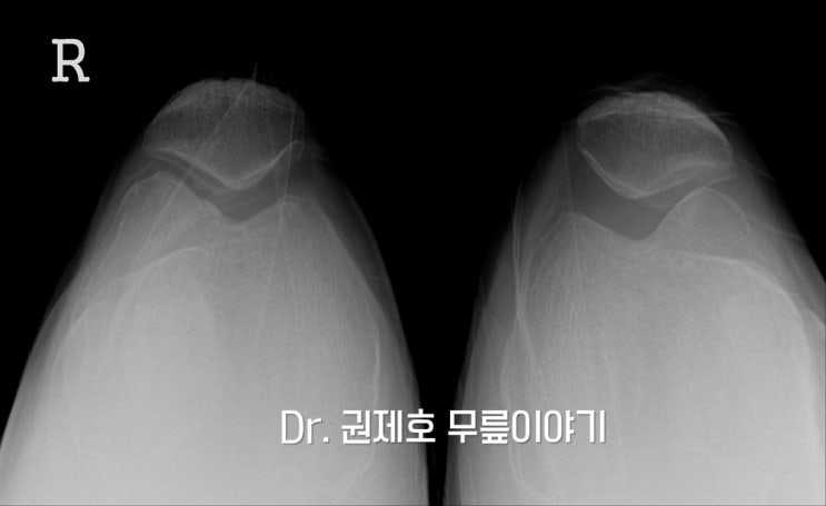  무릎연골연화증 치료 계단내려갈때 무릎통증