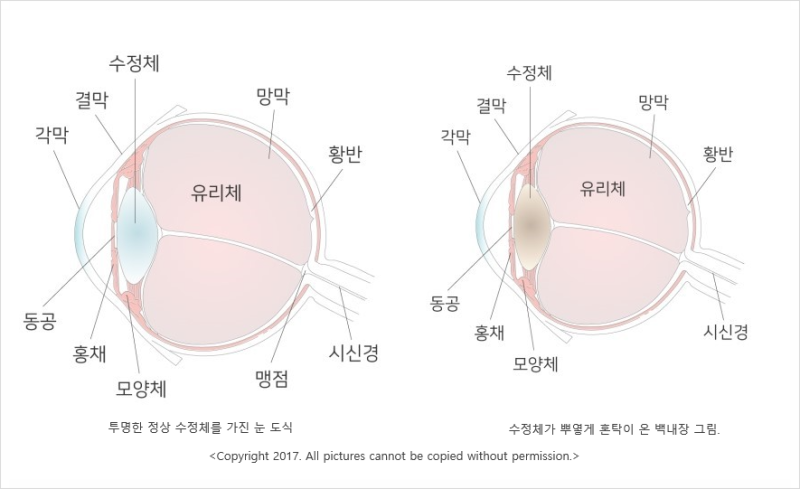 황반변성 증상과 예방법