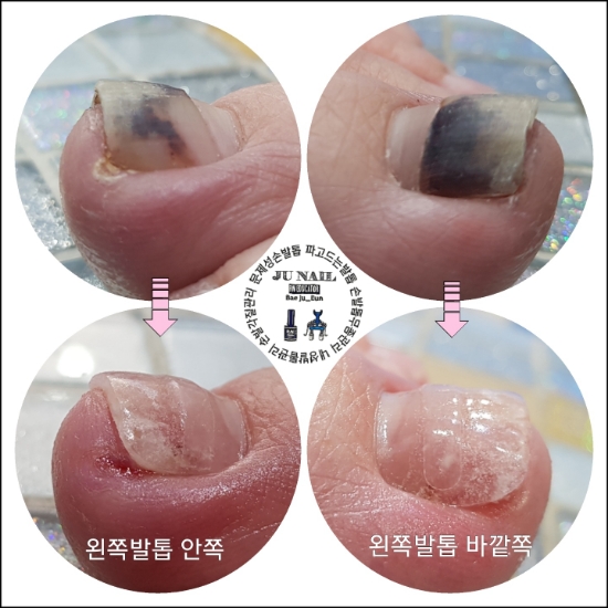 살을파고드는발톱/분당용인수원수지보정동백죽전동/주네일/파고드는발톱 살을파고드는발톱/분당용인수원수지보정동백죽전동/주네일/파고드는발톱
