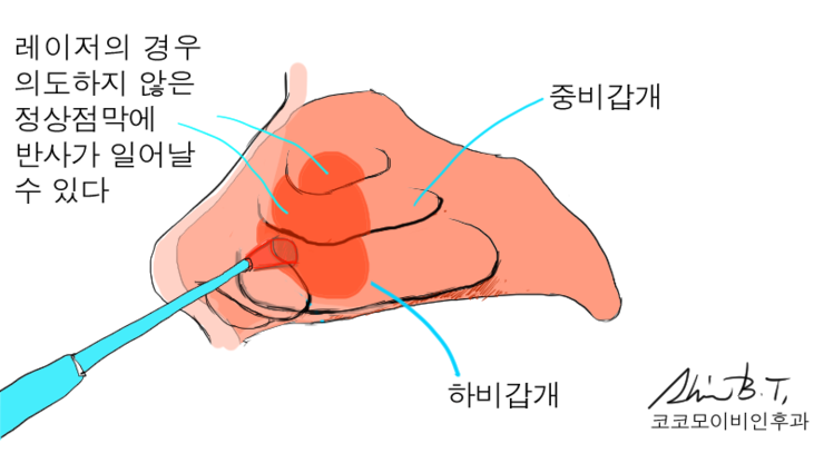  만성비염수술 방법 중에서 가장 확실한 고주파비염수술 