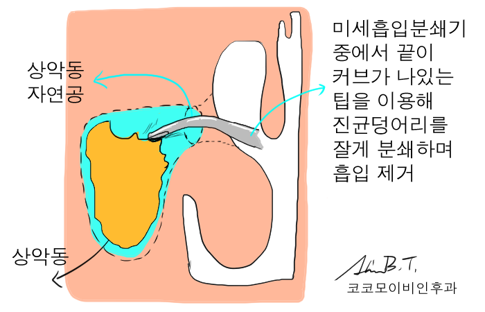  한쪽코막힘을 유발하는 코물혹과 진균성부비동염의 수술