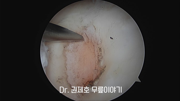  연골줄기세포 이제는 무릎관절내시경수술