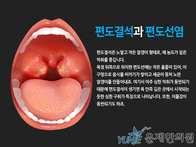 편도결석 증상 심한 구취의 원인