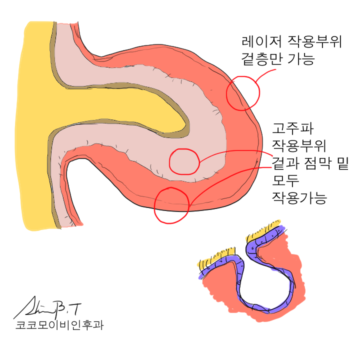  만성비염수술 효과와 통증 걱정은 이제 그만