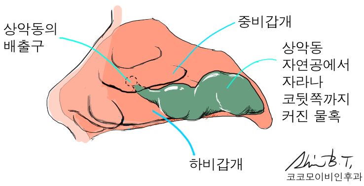  코 물혹 수술은 특화된 기구를 사용해야