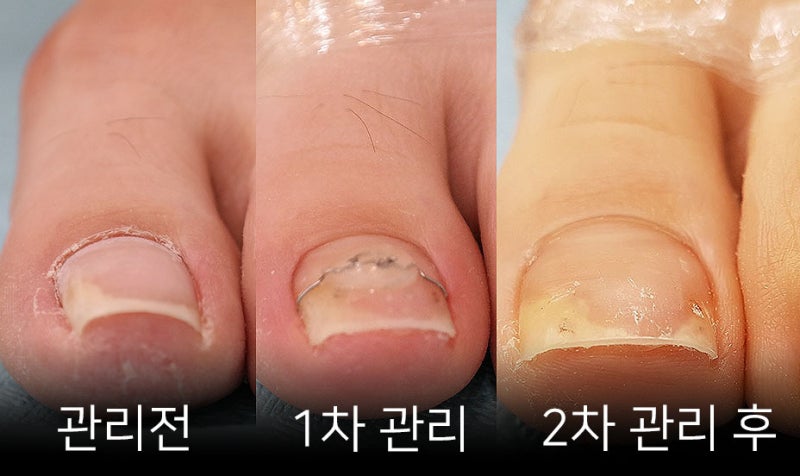 출산 후 내성발톱 교정기 3TO 관리후기 : 네이버 블로그 출산 후 내성발톱 교정기 3To 관리후기 : 네이버 블로그