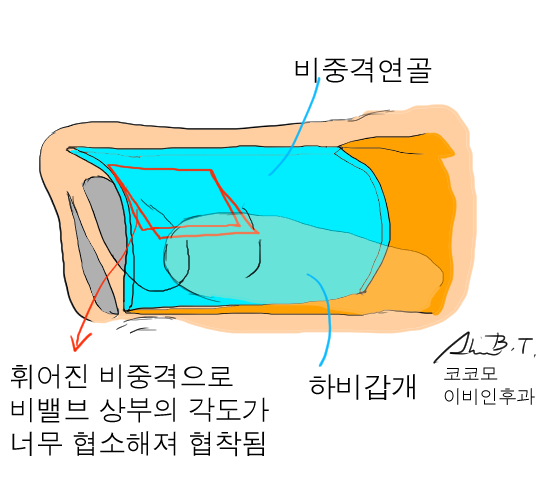  비중격만곡증 수술의 결정적인 핵심은 바로 비밸브