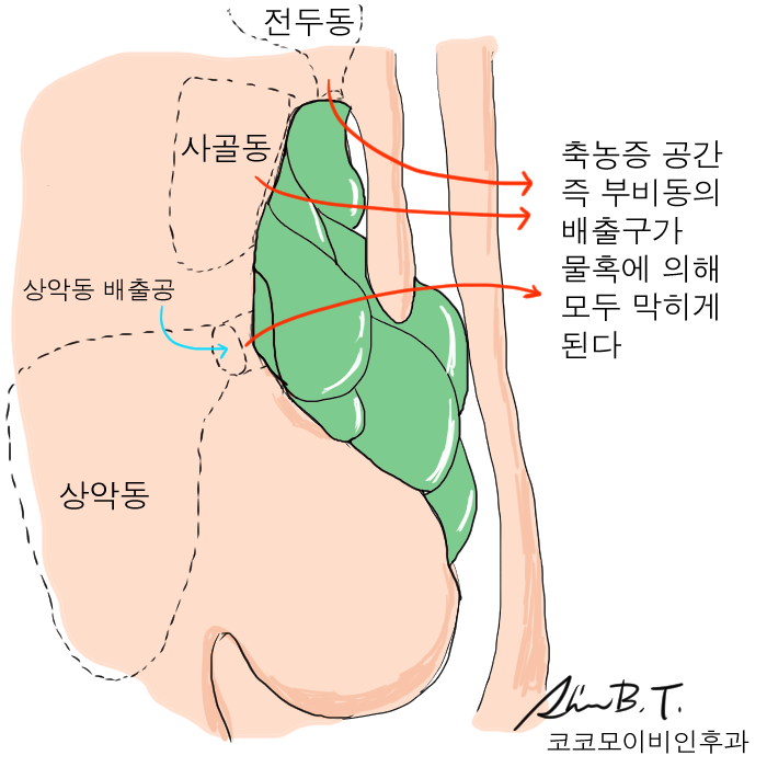 코 물혹 수술 시에는 반드시 축농증 부비동염을 확인해야