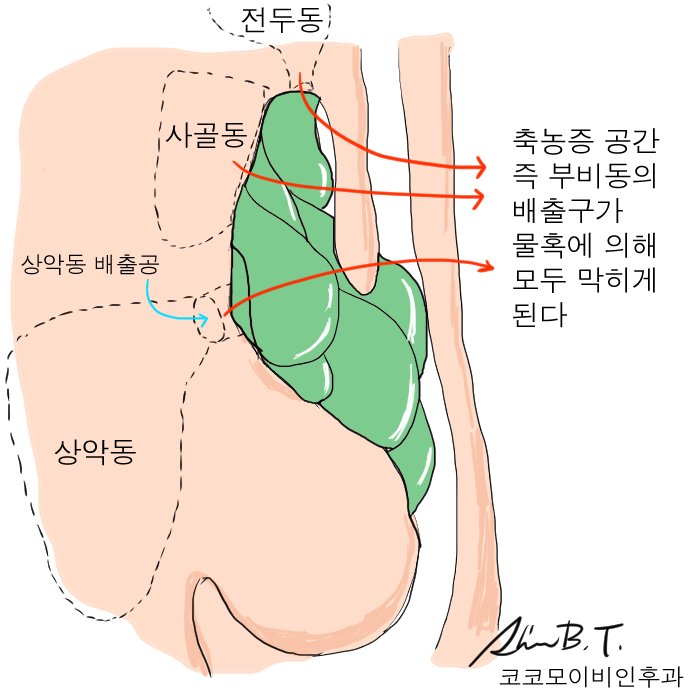 코 물혹 수술 시에는 반드시 축농증 부비동염을 확인해야