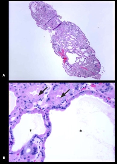 위 용종, 위저선 용종, Gastric polyps, fundic gland polyps : 네이버 블로그