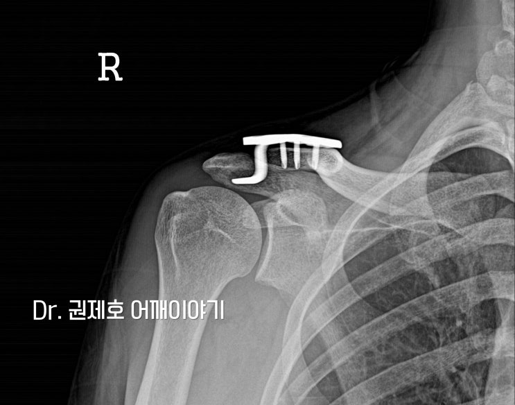  어깨뼈돌출 튀어나온 쇄골