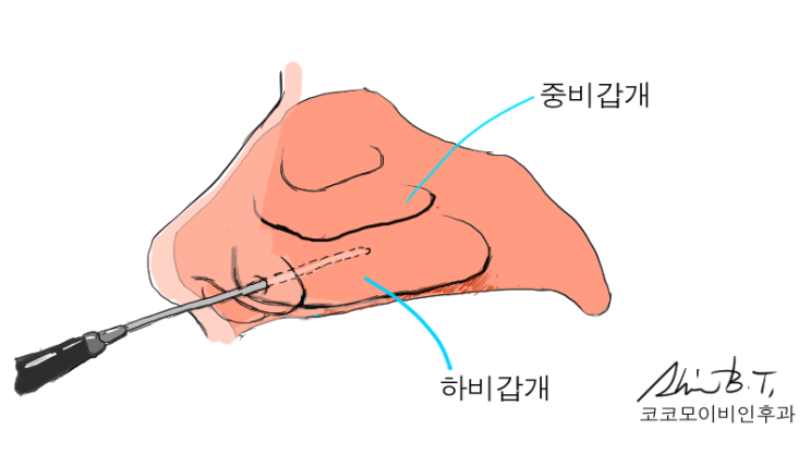  비후성비염수술은 역시 고주파비염수술이 대세